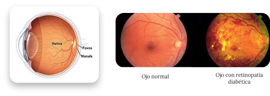 Retinopatía Diabética