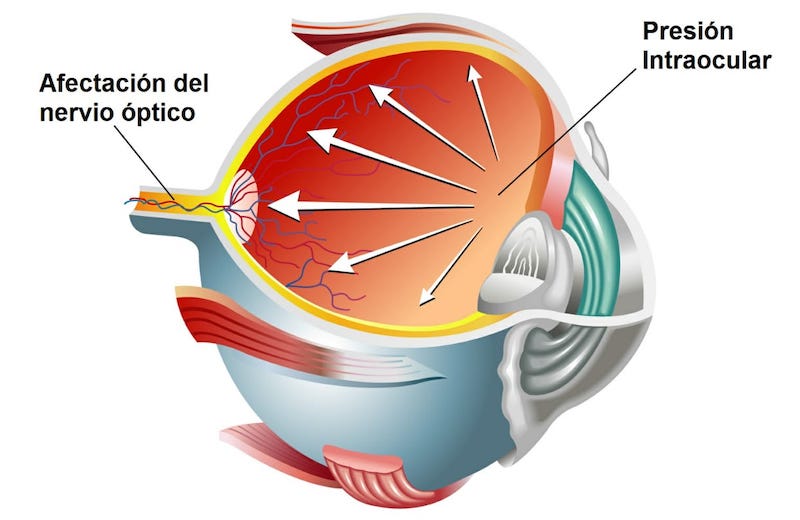 Glaucoma