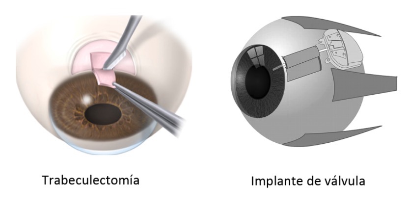 Glaucoma quirúrgico